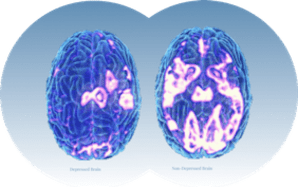 Is TMS Safe & Proven?